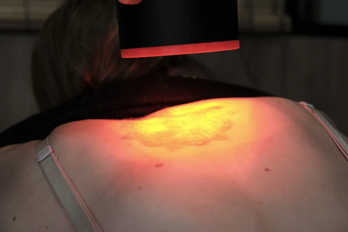 Laser tattoo removal session in Barcelona