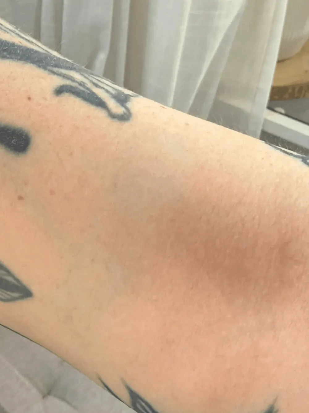 Tattoo after treatment
