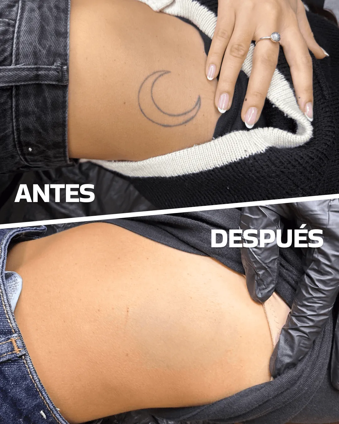 Laser tattoo removal before and after (case 1)