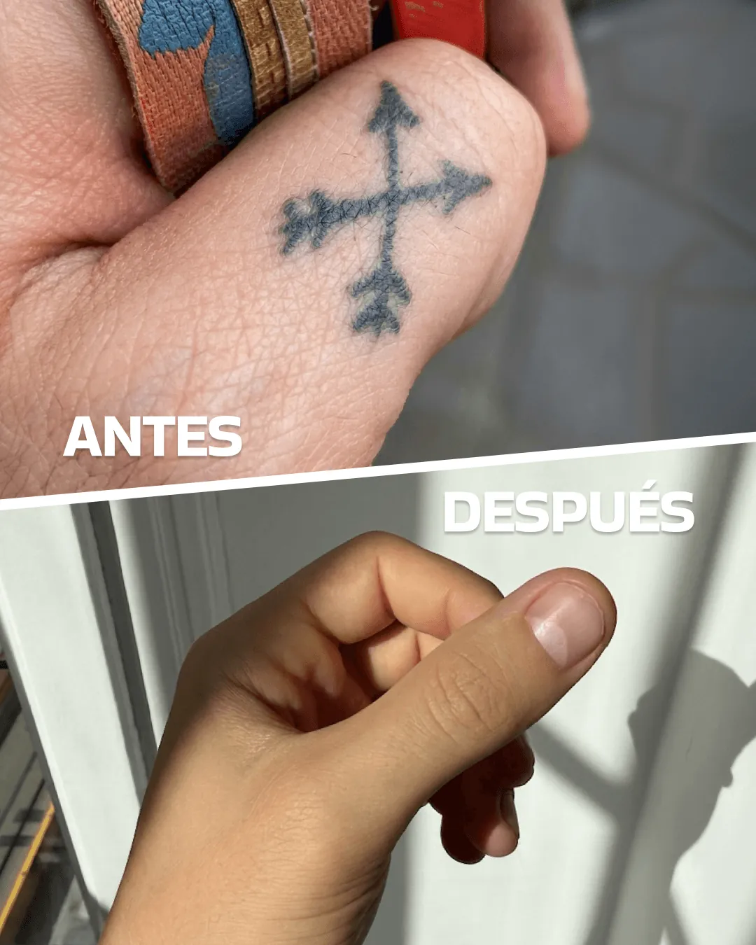 Laser tattoo removal before and after (case 2)