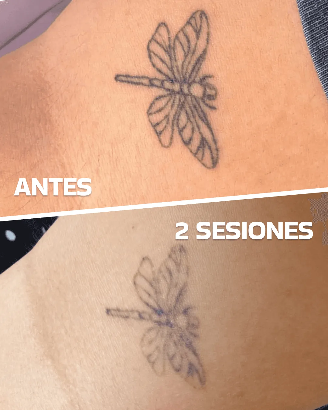Laser tattoo removal before and after (case 3)