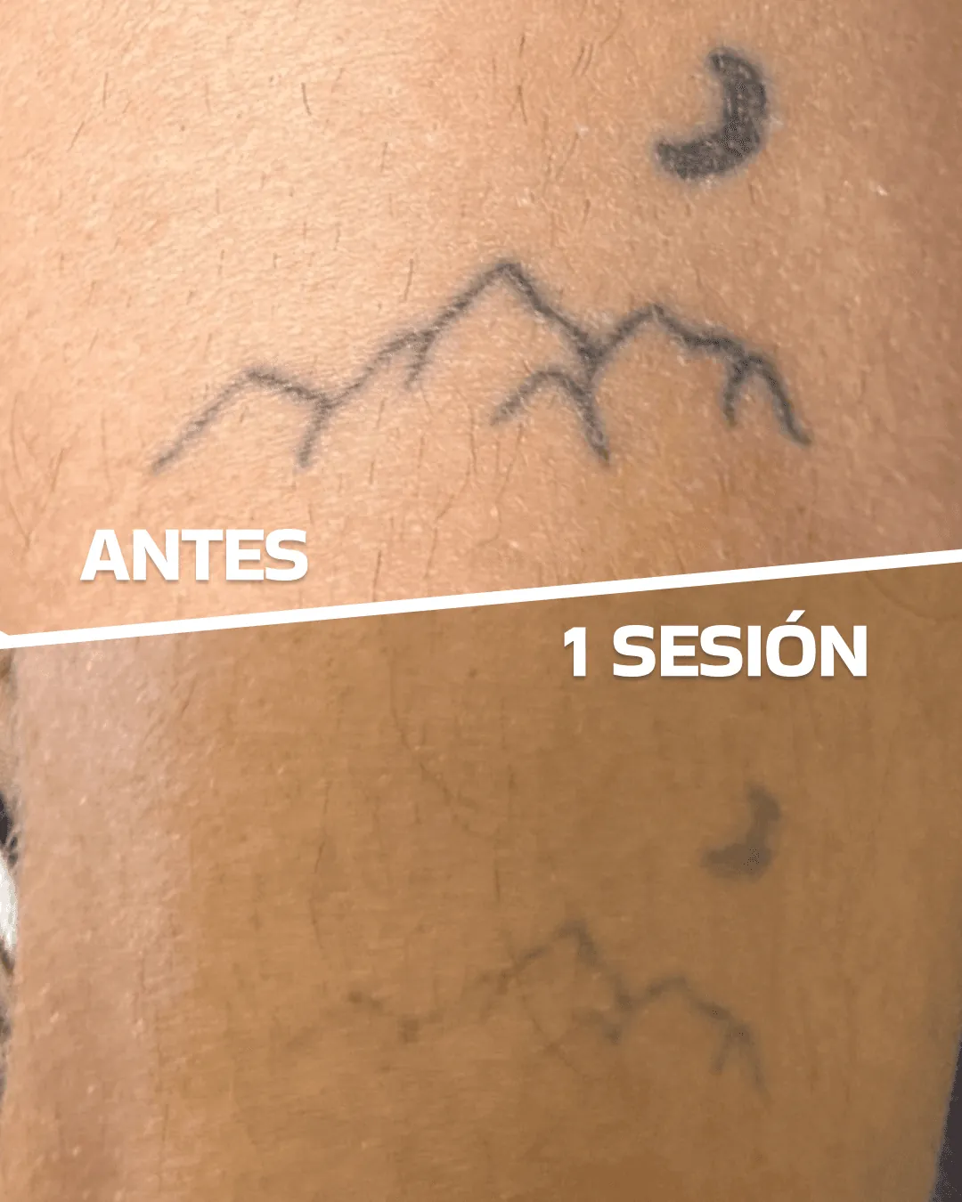 Laser tattoo removal before and after (case 4)